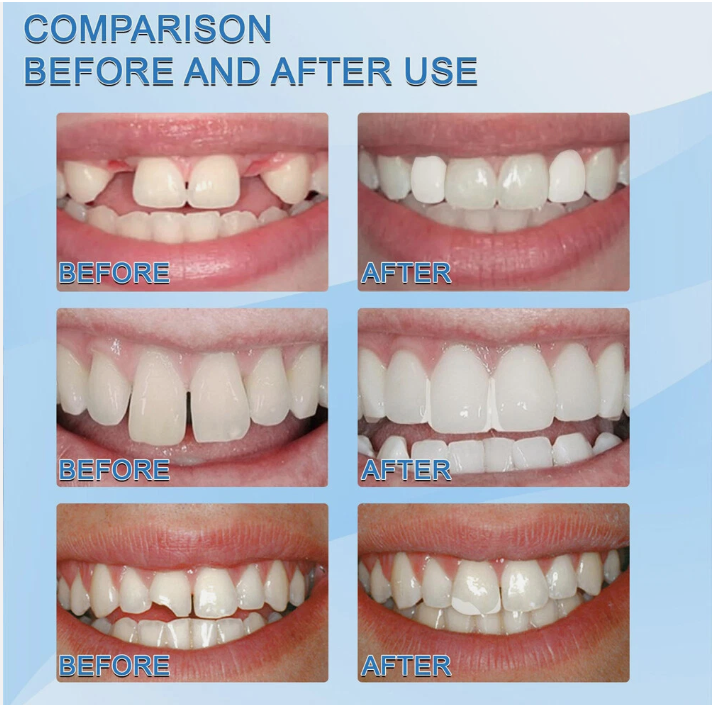 Kit de Resina Dental Profesional – Repara tu Sonrisa en Minutos desde Casa