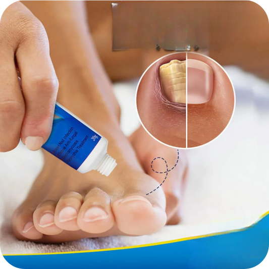 Crema Anti Hongos para los Pies | NailFungus®