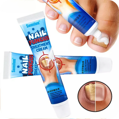 Crema Anti Hongos para los Pies | NailFungus®